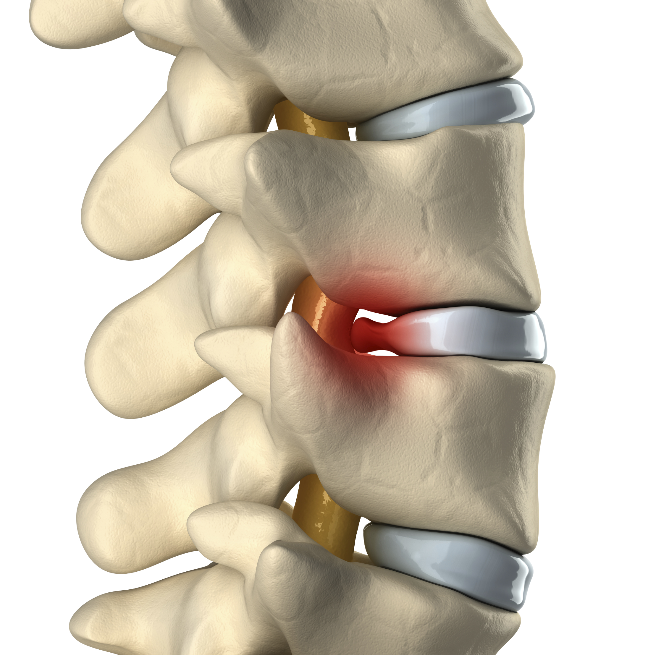 Spinal Disc Protrusion